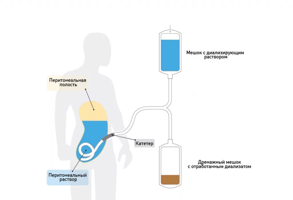 Раствор для катетера. Схема проведения перитонеального диализа. Аппарат для перитонеального диализа схема. Методика проведения перитонеального диализа. Гемодиализ и перитонеальный диализ.