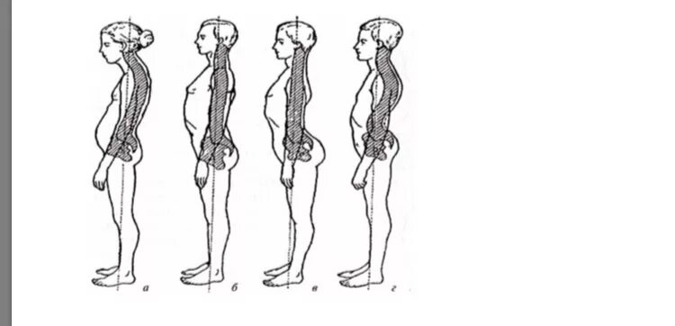 Сиповка отличия. Кифолордотическая осанка упражнения. Типы нарушения осанки. Нарушение осанки в сагиттальной плоскости. Изображение типов осанки человека.