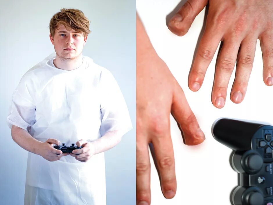 Деформация рук геймера. Руки геймера. Последствия компьютерных игр. Нападение большого пальца