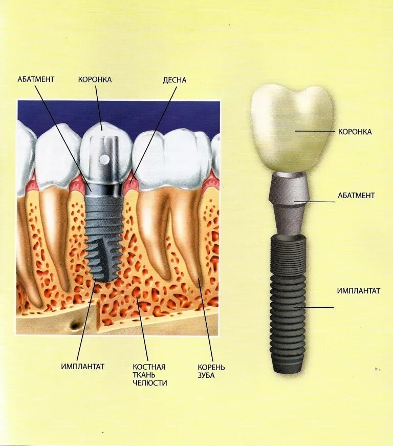Зубной имплант абатмент. Абатмент строение. Строение дентального имплантата. Имплантат абатмент коронка.