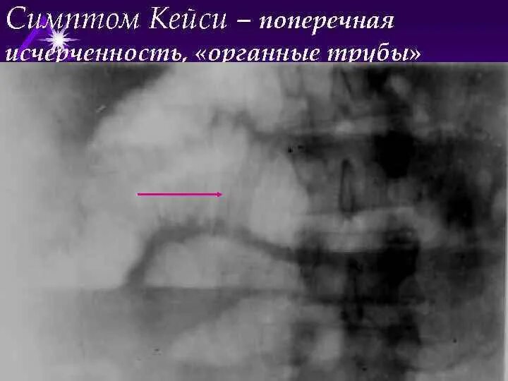 Симптом чаши. Чаши клойбера при кишечной непроходимости. рентген брюшной полости чаши клойбера. органные трубы кишечная непроходимость.