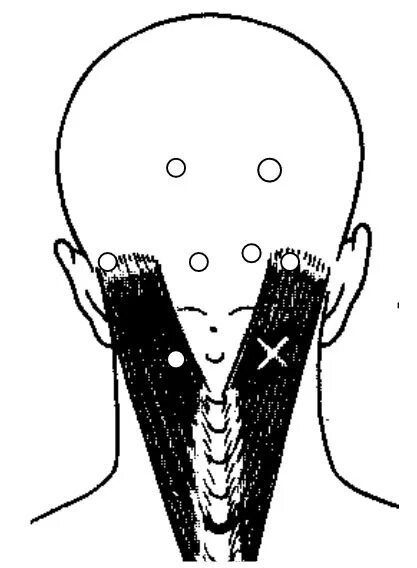 Болевые триггерные точки у основании черепа. Триггерные точки на затылке и шее. При нажатии на затылок