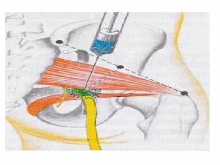 Нервная блокада. Блокада седалищного нерва анестезия. Блокада плечевого сплетения анатомия. Блокада запирательного отверстия. Блокада пудентального нерва.