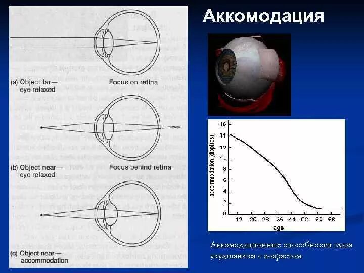 Аккомодация определение. Состояние аккомодации глаза. Состояние напряжения аккомодации фокус. Аккомодация и Возраст. Состояния аккомодации глаза таблица.