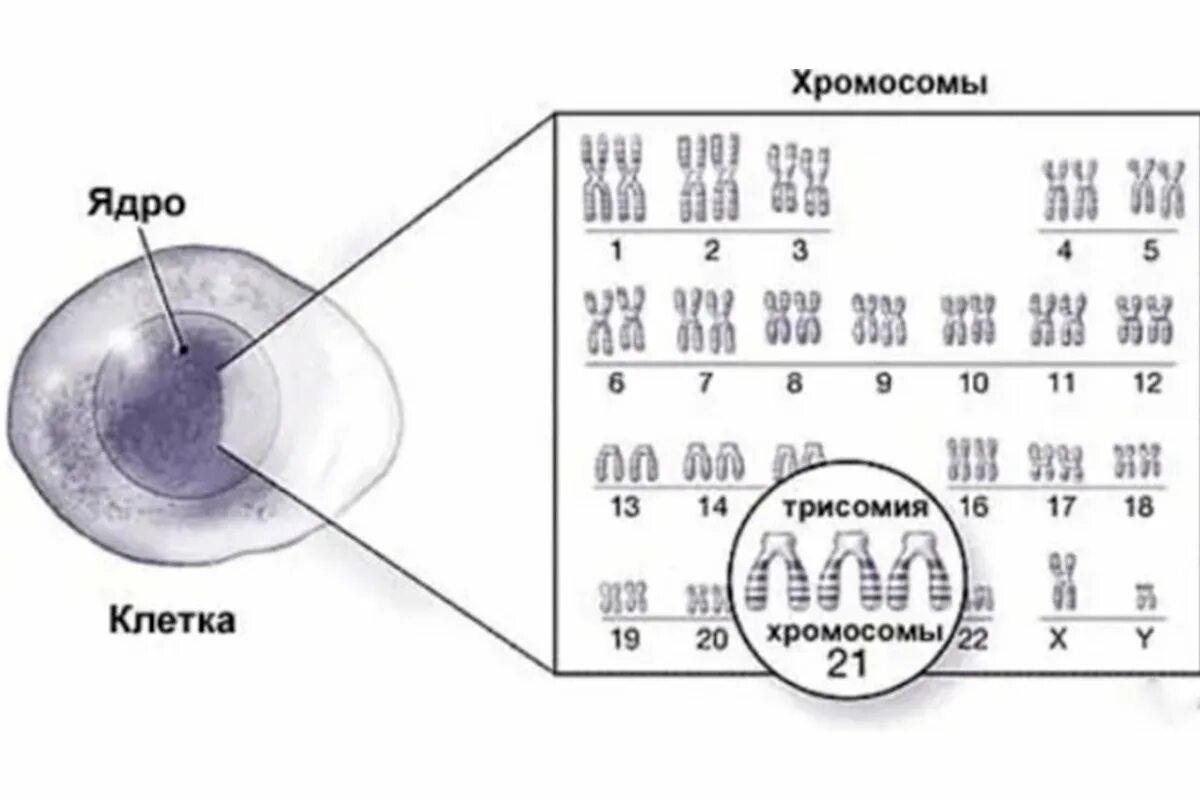 Синдром Дауна (трисомия по 21 паре хромосом). Синдром Дауна трисомия 21 хромосомы. Синдром Дауна трисомия по 21 хромосоме. Трисомия по 21 хромосоме синдром. Синдром дауна лишняя хромосома