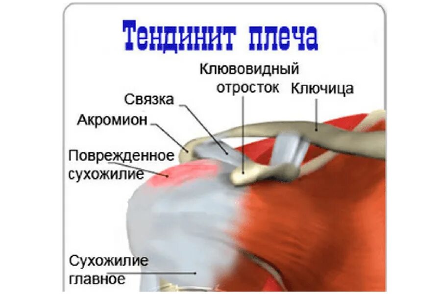 Ноющая боль в плече. Тендинит сухожилия бицепса плечевого сустава. Воспаление сухожилия подостной мышцы. Воспаление в сухожилии надостной мышцы. Тендинопатия сухожилия надостной мышцы плечевого сустава.