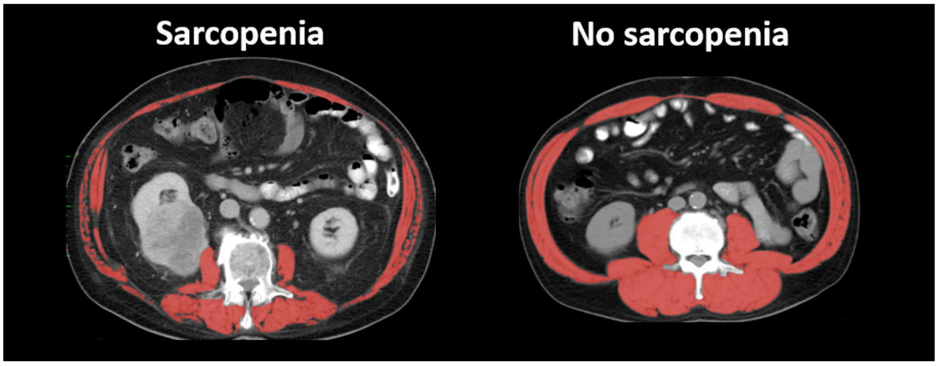 Саркопения лечение отзывы. Саркопения на кт. Саркопения мрт. Мрт при саркопении. Старческая саркопения.
