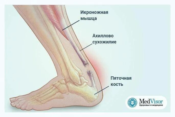 Почему болят сухожилия на ногах. Строение ахиллова сухожилия. Связка ахиллова сухожилия. Иннервация ахиллова сухожилия. Топография ахиллова сухожилия.