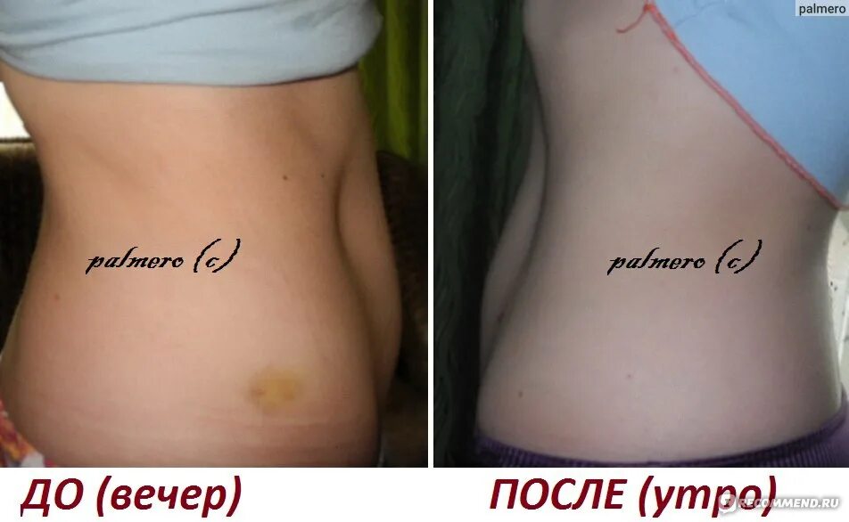 Фуросемид до после. Фуросемид для похудения Результаты. Фуросемид до и после фото. Фуросемид похудение до и после.