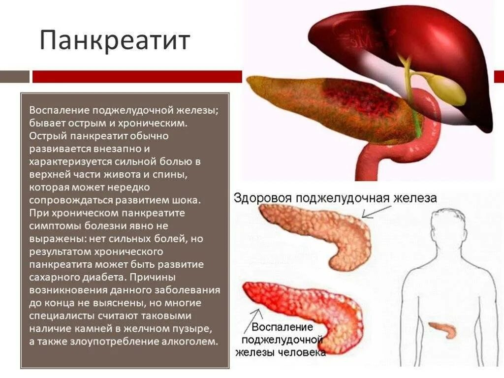 Панкреатите сколько раз в день. Острый панкреатит хронический панкреатит. Панкреатит заболевание поджелудочной железы симптомы. Болит поджелудочная хронический панкреатит. Панкреатин поджелудочная железа.