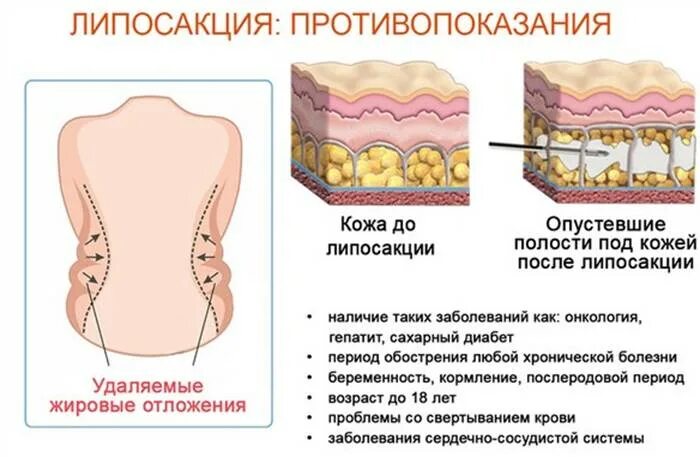 Лазерный липолиз противопоказания. Лазерная кавитация липолиз. Лазерно диодный липолиз. Лазерный липолиз противопоказания. Лазерный диодный липолиз.