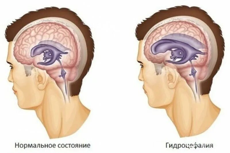 Гидроцефалия головного мозга. Гидроцефалия головного мозга у ребенка. Наружная гидроцефалия головного мозга.