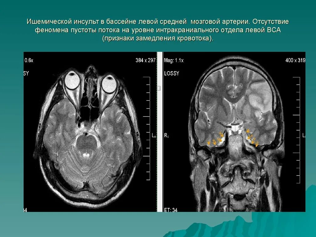 Бассейн левой средней мозговой артерии. ОНМК В бассейне левой средней мозговой. Инсульт в бассейне средней мозговой артерии кт. Инсульт бассейн левой средней мозговой артерии кт.