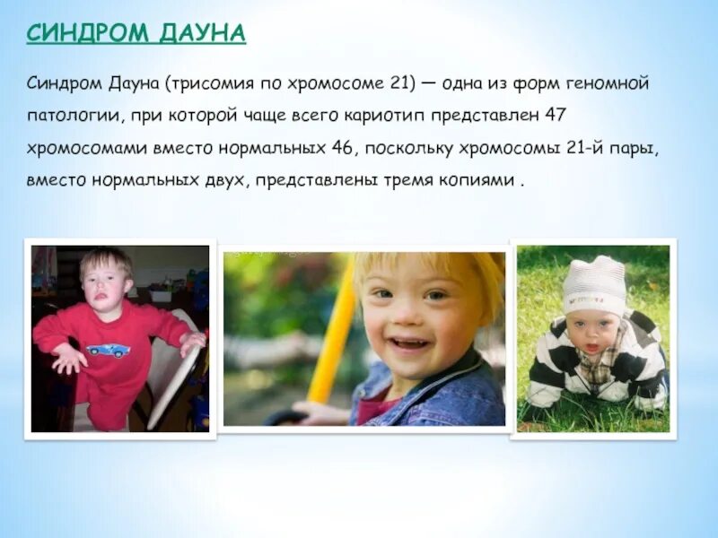 Синдром дауна это чаще всего. Синдром дауна трисомия. синдром дауна 47 хромосом. синдром дауна кариотип.