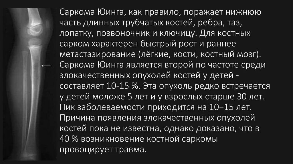 Диагноз саркома. Рентген при саркоме Юинга. Саркома Юинга рентген признаки. Опухоль Юинга бедренной кости. Саркома кости голени симптомы.