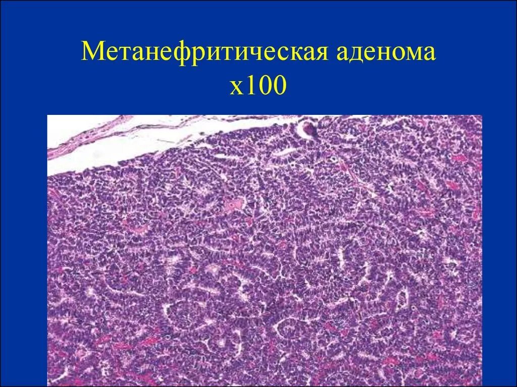 Аденома молочной железы гистология. Карцинома предстательной железы микропрепарат. Базофильная аденома гипофиза гистология. Зубчатая аденома гистология. Липецк аденома.