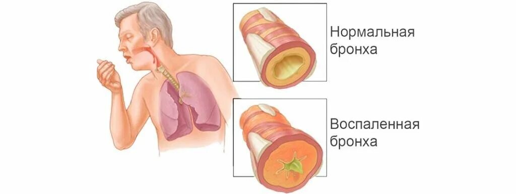 Аллергия и бронхит. Гнойно слизистая мокрота.