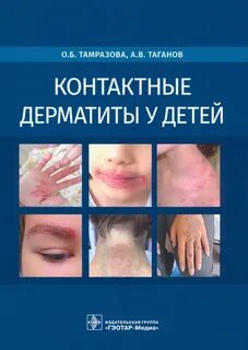 Контактный дерматит клинические рекомендации 2021