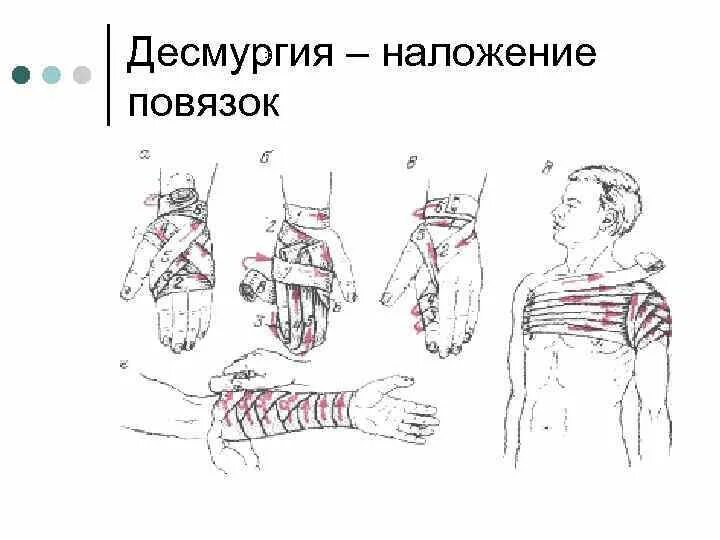 Десмургия наложение повязок. Десмургия в хирургии. Десмургия восьмиобразная повязка. Наложение хирургической повязки. Десмургия техника наложения повязок.