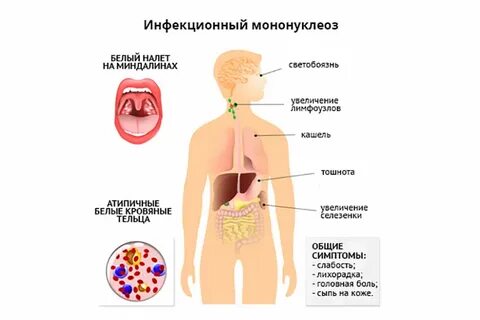 Мононуклеоз у взрослых симптомы и лечение инфекционный