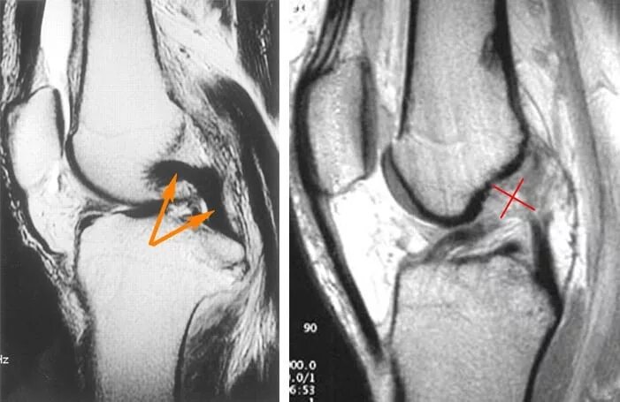 Разрыв пики. Разрыв ПКС коленного сустава. Гемартроз коленного сустава мрт. Задняя крестообразная связка мрт. Повреждение мениска коленного сустава рентген.