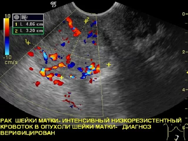 Рак 0 матки. Ультразвуковое исследование шейки матки при раке.. Рпкмшейки матки на УЗИ. Опухоль шейки матки на УЗИ.