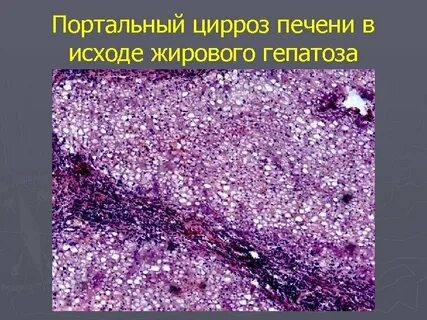 Цирроз исход