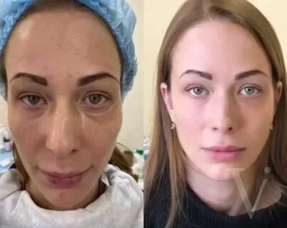 Сферогель под глаза отзывы