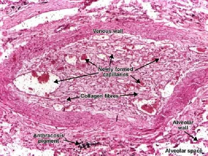 Обтурирующий тромб гистология. Фибриновый тромб гистология. Реканализация тромба микропрепарат. Обтурирующий красный тромб в Вене. Организация тромба