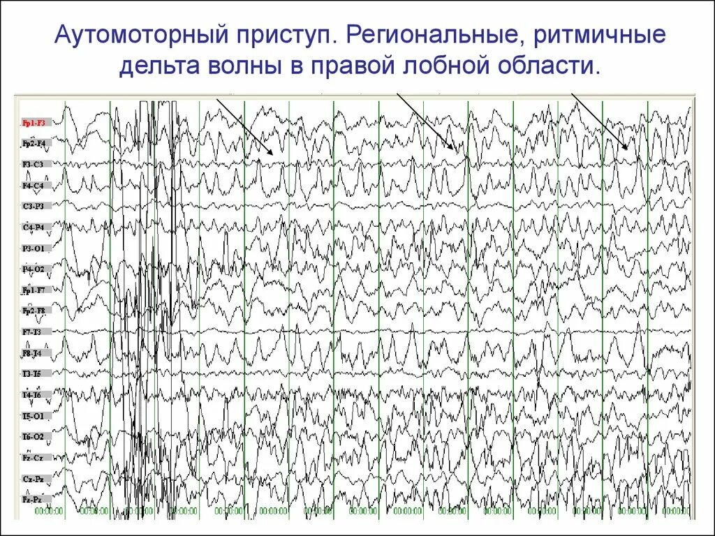 Диффузная эпилептиформная активность. ЭЭГ при эпилептическом припадке. Вспышки Дельта волн на ЭЭГ. ЭЭГ больного эпилепсией. Эпилептический приступ на ЭЭГ.