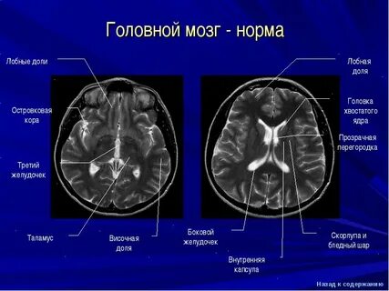 Мрт мозгового мозга