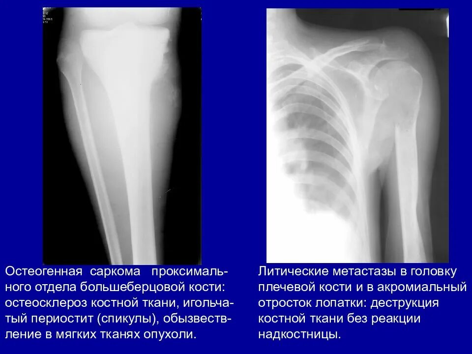 Остеосаркома плечевой кости рентген. Метастаз остеосаркомы. Саркома юинга гистология. Остеогенная саркома бедренной кости кт. Метастаз остеосаркомы.