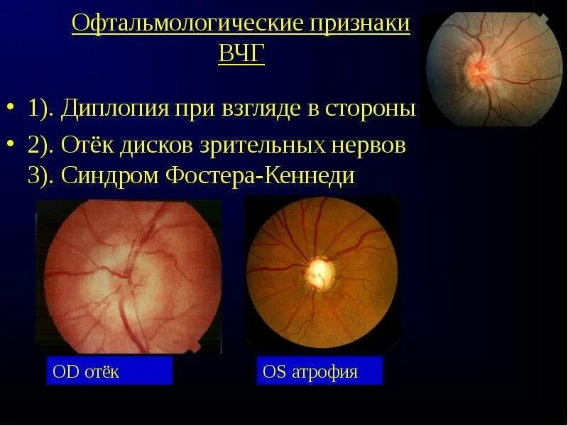 Атрофия головного мозга 1. Офтальмоскопический синдром Фостера-Кеннеди. Атрофия диска зрительного нерва. Отечный диск зрительного нерва. Отек диска зрительного нерва.