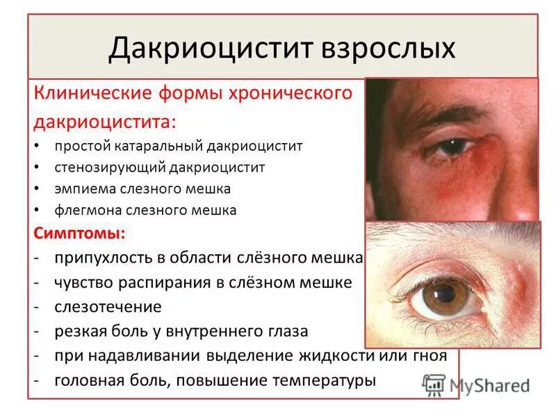 Слезотечение причины и лечение у взрослых
