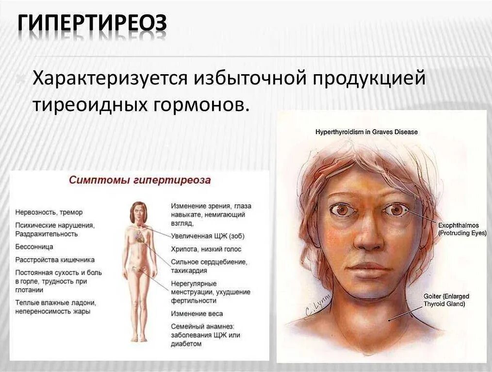 Гипертиреоз симптомы и лечение. Гипертиреоз щитовидной железы симптомы. щитовидная железа тиреотоксикоз гипертиреоз. заболевания щитовидной железы (гипертиреоз, тиреотоксикоз).. клинические симптомы гипертиреоза.
