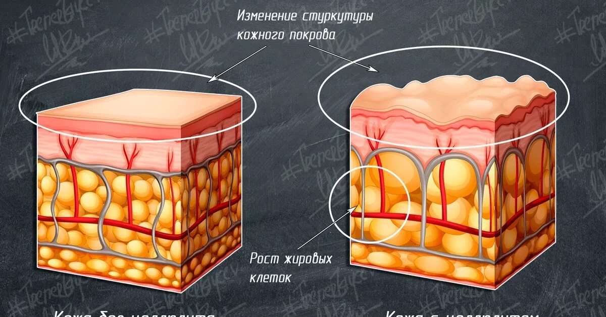 Подкожно жировая клетчатка у женщин