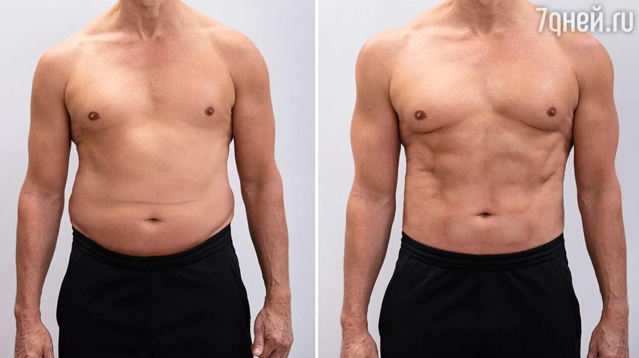 Удаление жира у мужчин. Абдоминопластика живота у мужчин до и после. Абдоминопластика у мужчин до и после. До и после похудения мужчины. Липосакция у мужчин до и после.