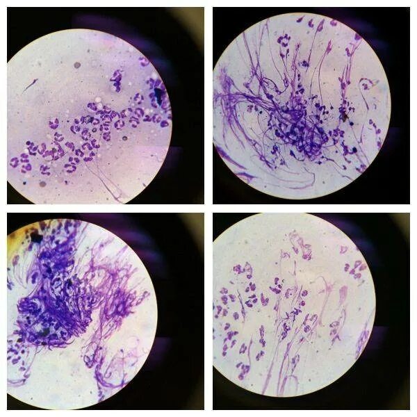 Микроскопия мокроты спирали Куршмана. Спирали Куршмана микроскопия мазок. Исследование мокроты спирали Куршмана. Спирали Куршмана микроскопия. Реакция на слизи