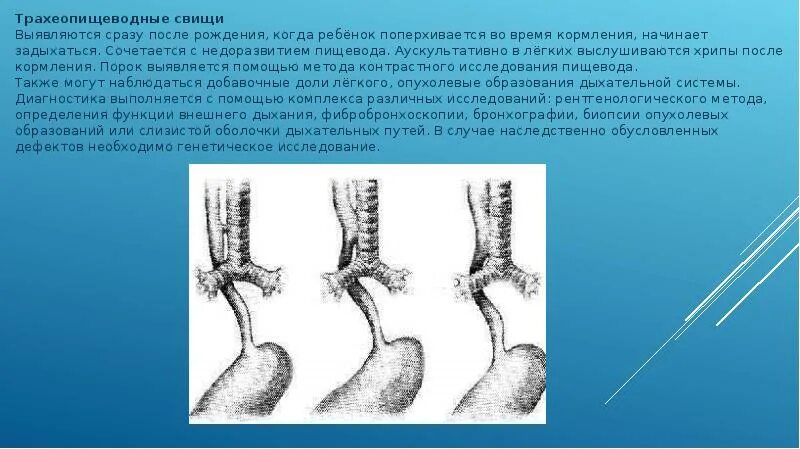 Трахеобронхопищеводные свищи. Врожденный пищеводно-трахеальный свищ. Пищеводно трахеальный свищ рентген. Пищеводно-бронхиальные свищи. Https studfiles net preview page 2