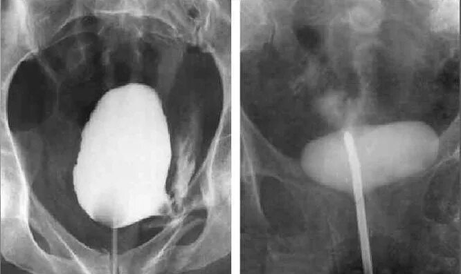 Нейрогенный мочевой пузырь цистография. Цистография разрыв мочевого пузыря. Нейрогенный мочевой пузырь рентген.