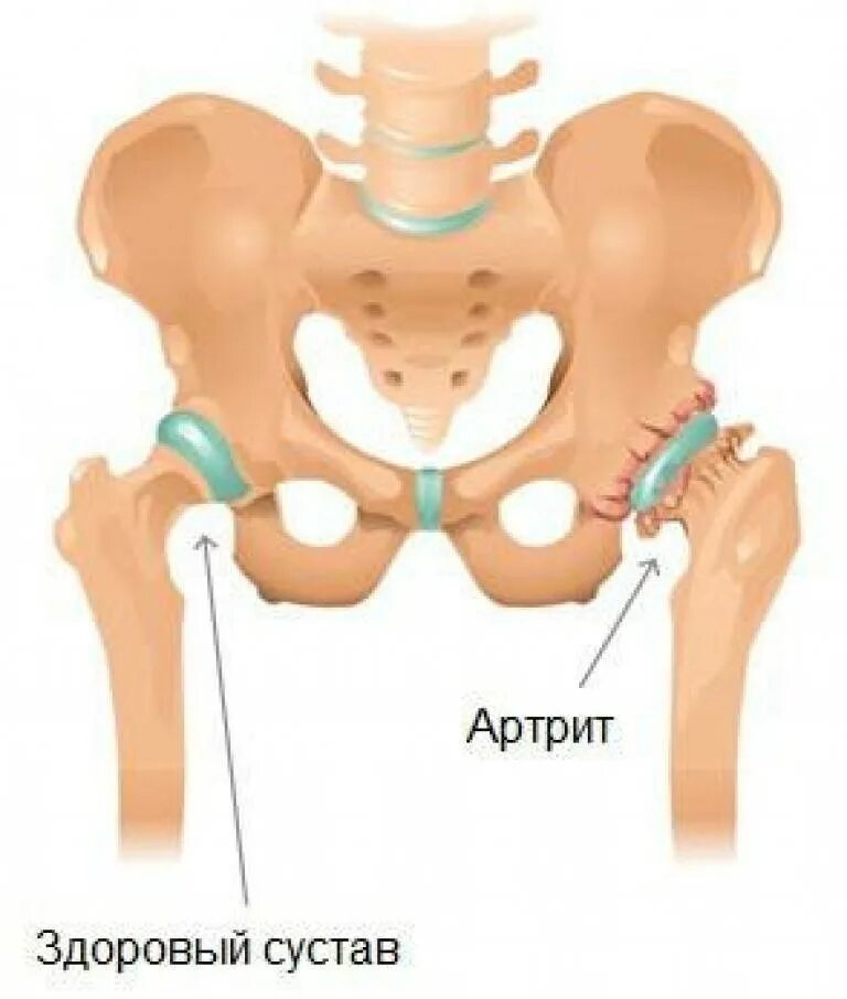 Коксит тазобедренного сустава. Коксит тазобедренного сустава у детей. Остеоартрит тазобедренного кость. Артрит тазобедренного сустава. Медицина суставы тазобедренный