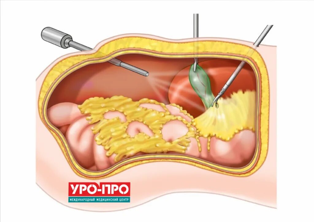 Удаление камня через проток. Холецистэктомия лапароскопия. ЖКБ лапароскопическая холецистэктомия. Камень в желчном пузыре операция лапароскопия.
