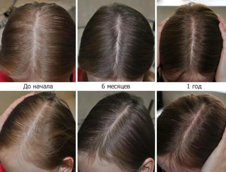 Миноксидил 2 для волос для женщин. Миноксидил 3 в 1. Миноксидил алерана эффект. Результаты роста волос