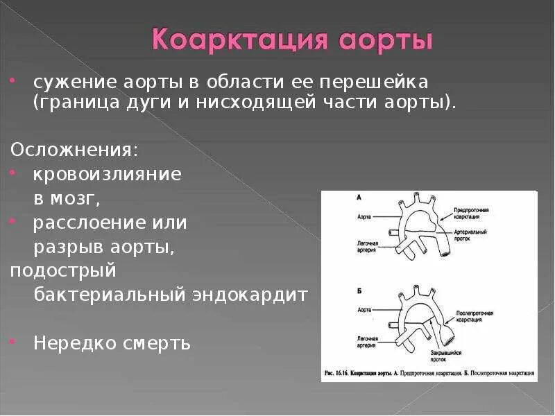 Градиент аорты норма. Диаметр перешейка аорты. сужение перешейка аорты. градиент на перешейке аорты норма. сужения перешейка дуги аорты.