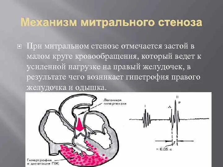 Митральный стеноз признаки. Механизм развития недостаточности сердца при митральном стенозе. Механизмы компенсации при митральном стенозе. Изменения сердца при митральном стенозе. При стенозе митрального клапана.