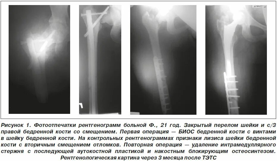 Осложнения после эндопротезирования тазобедренного сустава