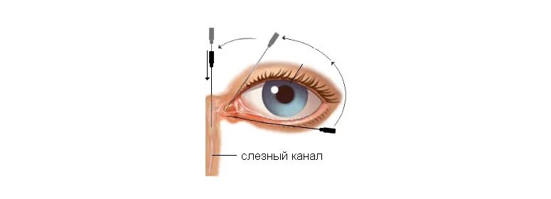 Как прочистить слезные каналы. Бужирование слезного мешка. Дакриоцистит зондирование канала. Непроходимость слезного канала зондирование. Расширение слезного канала у новорожденных.