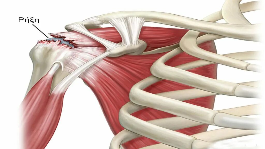 Мышцы ротаторной манжеты плеча. Манжета мышца. Манжета мышца. Манжет плечевого сустава. Вращательная манжета плечевого сустава анатомия.