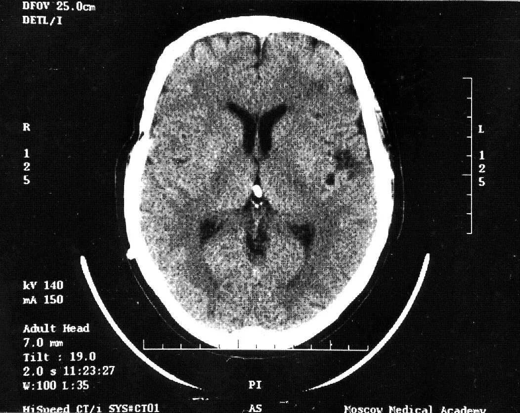 Операция гидроцефалия мозга. Гидроцефалия головного мозга мрт. Гидроцефалия головного мозга на кт. Вентрикулоперитонеальный шунт мрт. Кт вентрикулоперитонеального шунта.