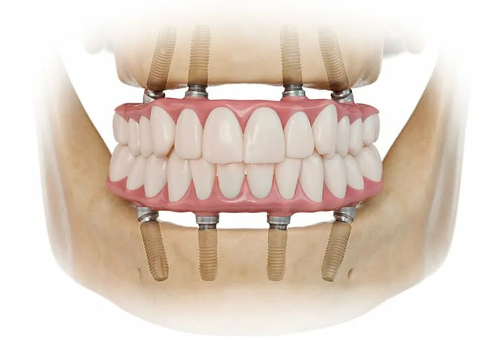 Имплантация зубов по технологии «all on 4». Балочный протез на 4 импл. 4 Импланта и несъемный протез.